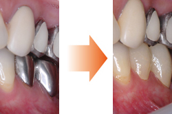 虫歯が大きい場合は部分的な詰めものではなく、被せものをします。